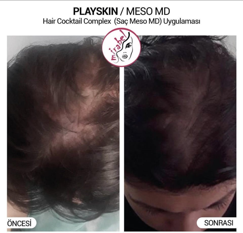 Playskin Liposome Technology Hair Cocktail Complex  Mezoterapi 8 li
