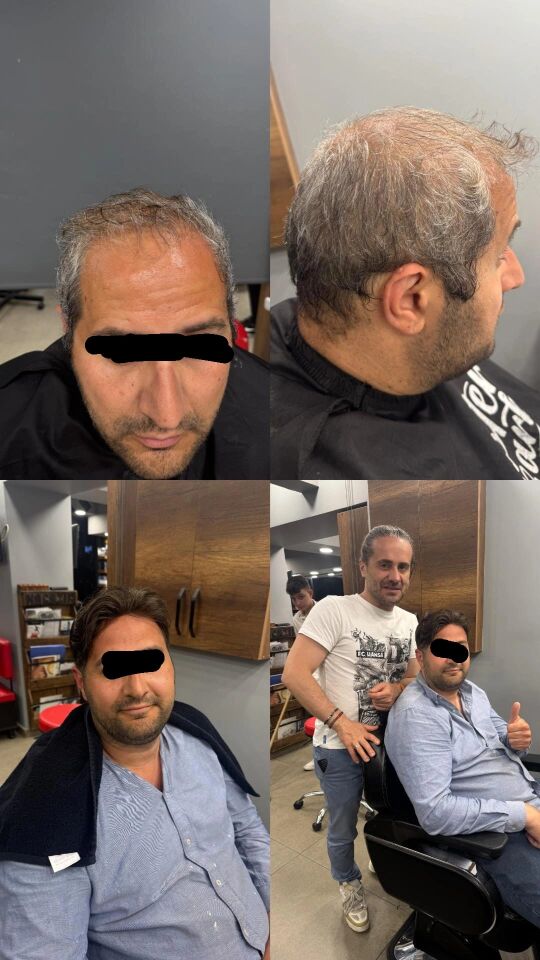 İnter Protez Saç - Avustralya QA8 7x10 1B-Koyu Kestane İnce Telli Her Yöne Taranabilen Alt Yapıda %100 İnsan Saçı