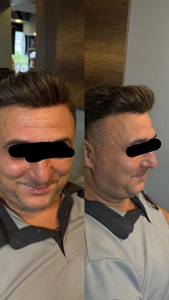 İnter Protez Saç - Avustralya QA8 6x10 1B-Koyu Kestane İnce Telli Her Yöne Taranabilen Alt Yapıda %100 İnsan Saçı