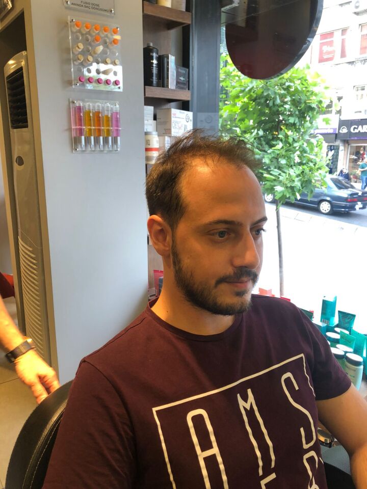 İnter Protez Saç - Avustralya QA8 8x10 1B-Koyu Kestane İnce Telli Her Yöne Taranabilen Alt Yapıda %100 İnsan Saçı